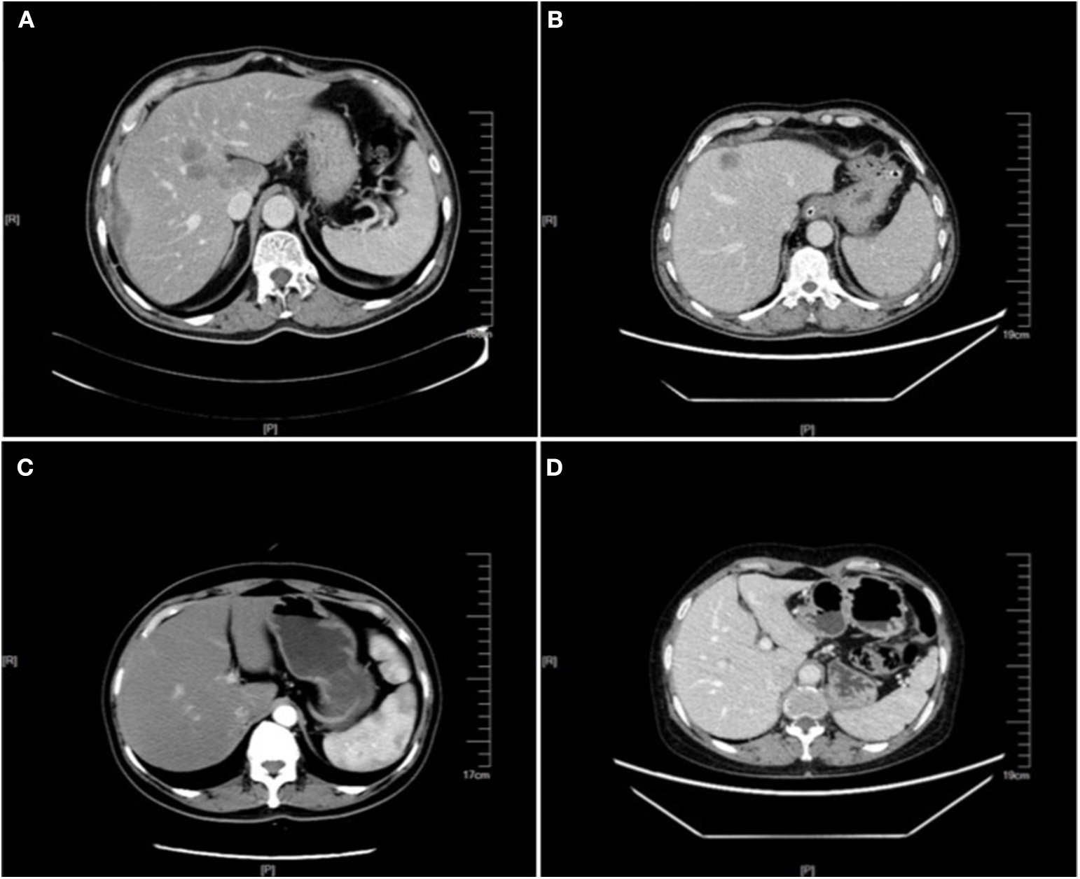 CT scan showing liver metastases